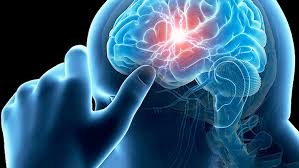 Nueva indicación permite detener un infarto cerebral en segundos