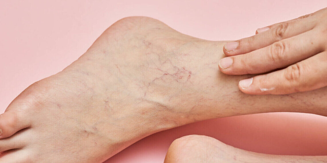 Várices afectan a 7 de cada 10 mexicanos que pasan más de 5 horas de pie o sentados por temas laborales o profesionales