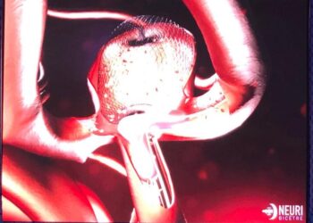 Innovación en el tratamiento de los aneurismas cerebrales en México