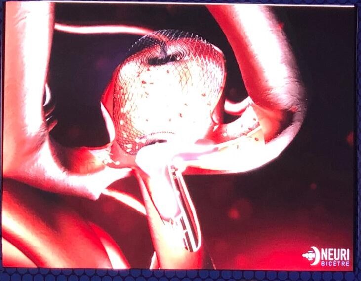 Innovación en el tratamiento de los aneurismas cerebrales en México