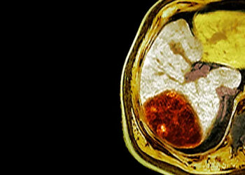 La oncología de trasplante transforma los resultados de los pacientes con tumores hepáticos inoperables