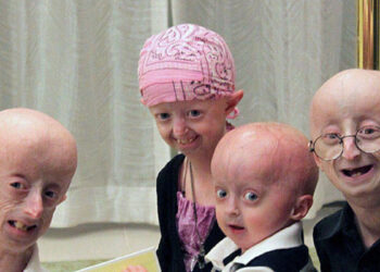 Al menos 10 millones de personas viven con una enfermedad rara en el país