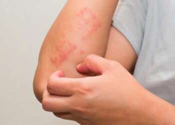 Se aprueba nueva terapia que mejorará la vida de pacientes con Psoriasis Pustulosa Generalizada en México