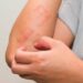 Se aprueba nueva terapia que mejorará la vida de pacientes con Psoriasis Pustulosa Generalizada en México