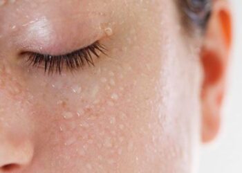 Cómo tratar la sudoración excesiva de la cara