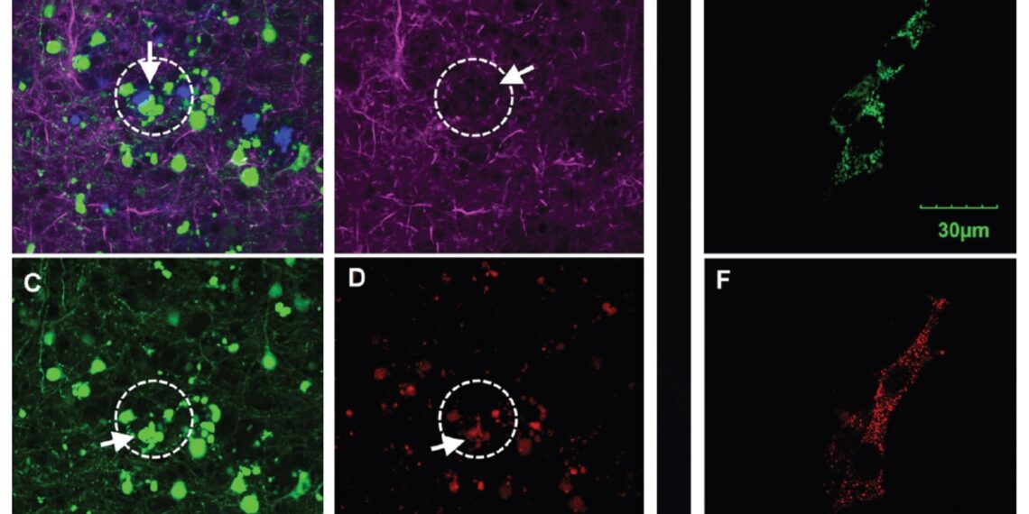 El cáncer de ovario y la enfermedad de Alzheimer tienen un punto en común