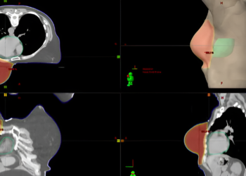 Puntuación de recurrencia del cáncer de mama