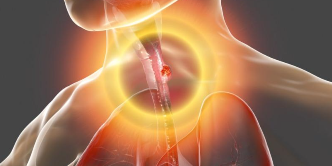 Cáncer de esófago más frecuente en hombres, no presenta síntomas en sus fases iniciales