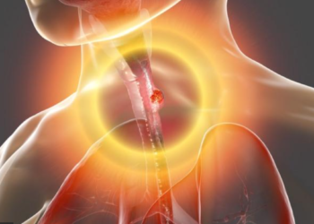 Cáncer de esófago más frecuente en hombres, no presenta síntomas en sus fases iniciales
