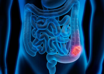 Cáncer de colon duplica su incidencia en los últimos diez años