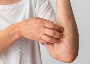 Secretaría de Salud emite aviso epidemiológico por sarampión