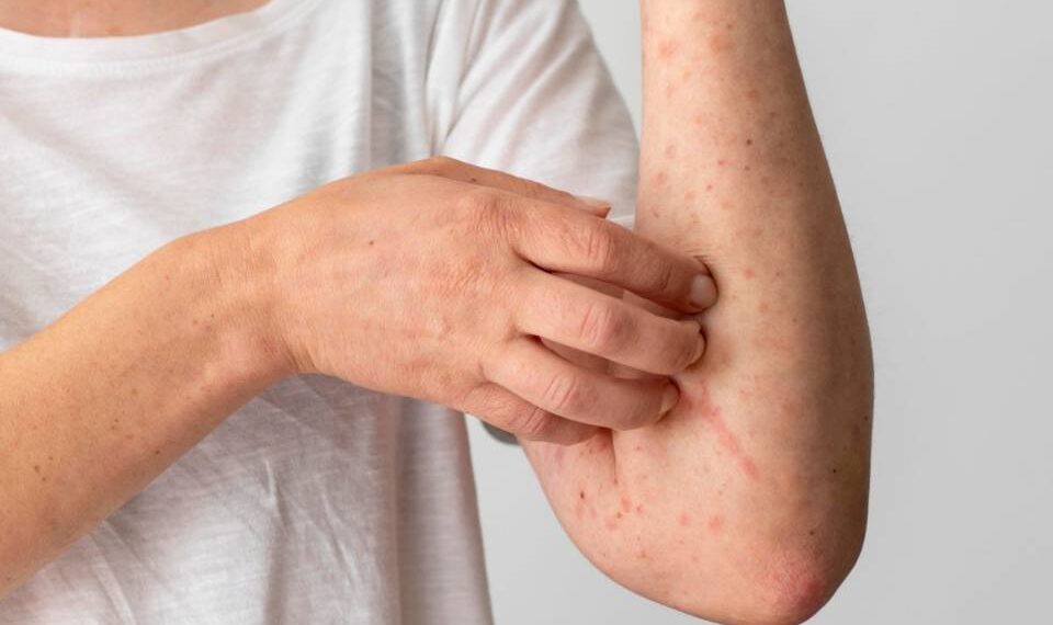 Secretaría de Salud emite aviso epidemiológico por sarampión