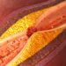¿Se puede revertir la enfermedad de las arterias coronarias?