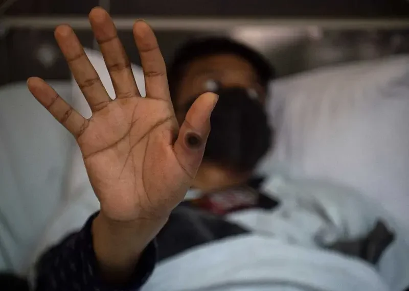 Suecia reporta su primer caso de viruela del mono fuera de África