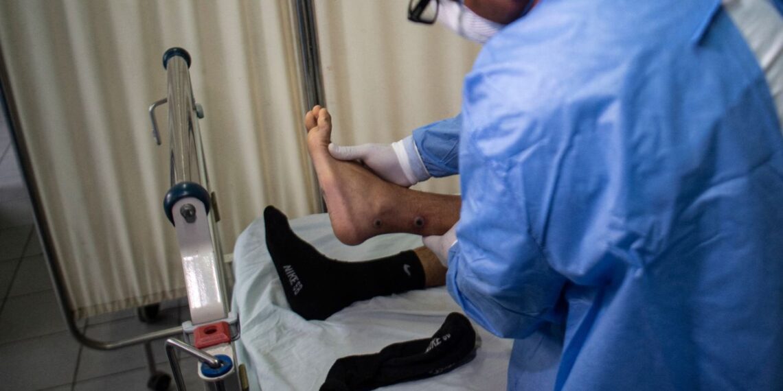 Comité Nacional para la Vigilancia Epidemiológica emite aviso por viruela de mono