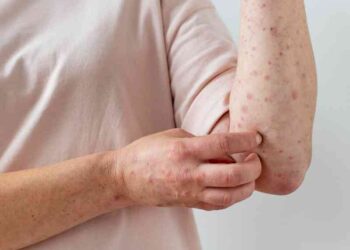 Reportan seis casos más en una semana en México  de Viruela del mono