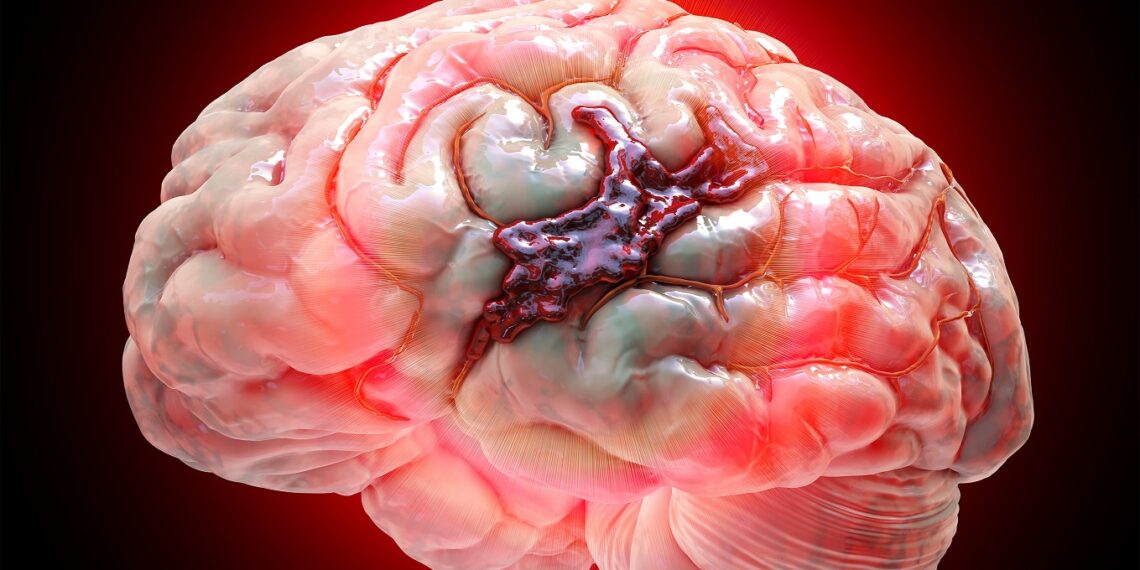 Modelos traslacionales en hemorragias cerebrales