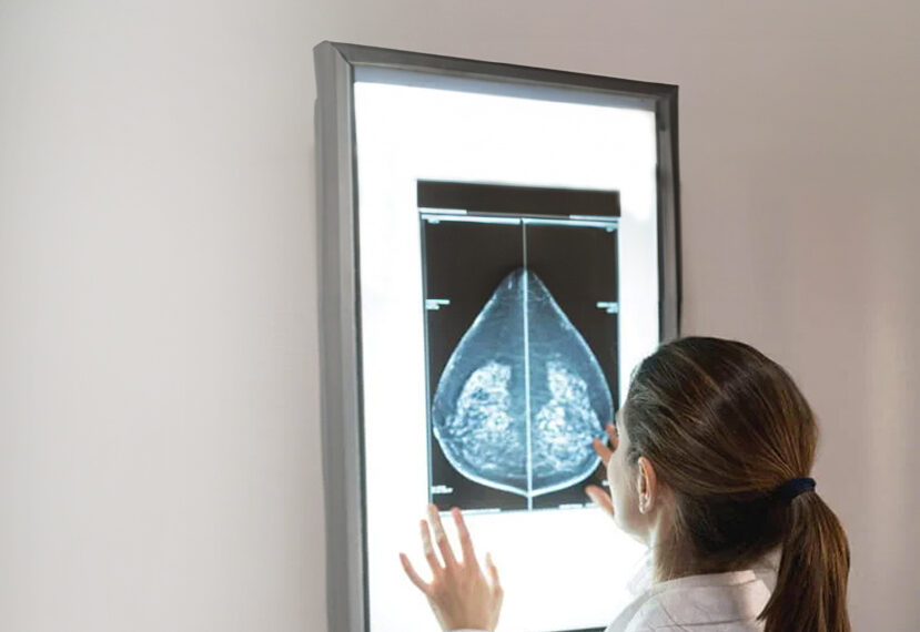 Guía para comprender las etapas del cáncer de mama