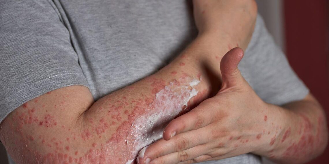 Llama FMD a desmitificar la psoriasis; es una enfermedad de la piel no contagiosa que se puede controlar con diagnóstico oportuno