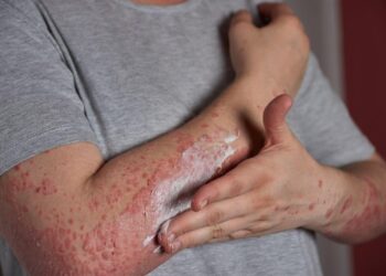 Llama FMD a desmitificar la psoriasis; es una enfermedad de la piel no contagiosa que se puede controlar con diagnóstico oportuno