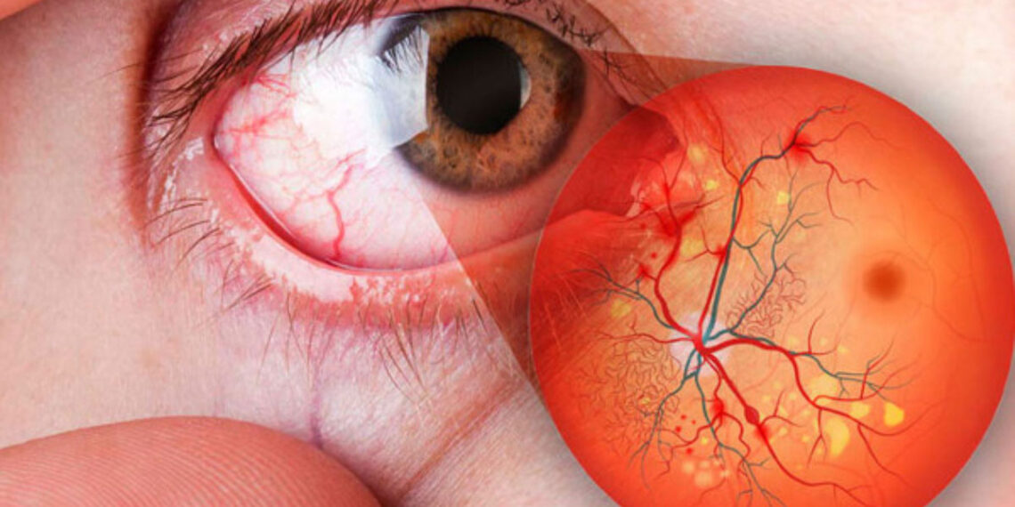 Retinopatía diabética,   responsable de 10% de los casos de ceguera en México