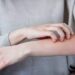 Psoriasis y dermatitis atópica: sensibilización, diagnóstico, tratamiento médico y atención psico-emocional