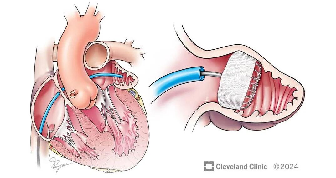 Implante cardíaco podría ser una alternativa para pacientes con fibrilación auricular