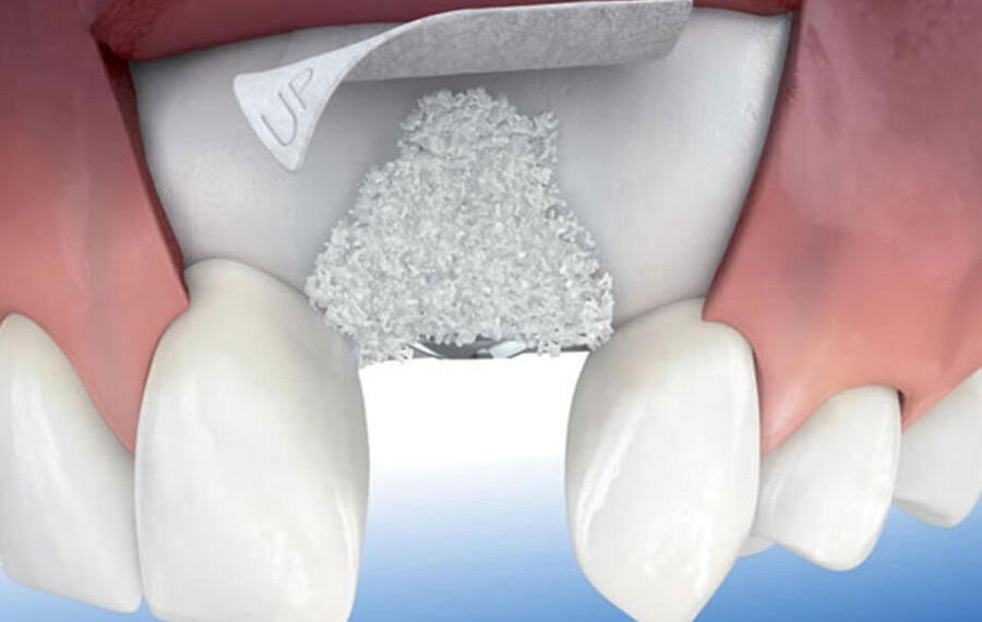 Implantes disolubles. Ciencia aplicada en la regeneración ósea