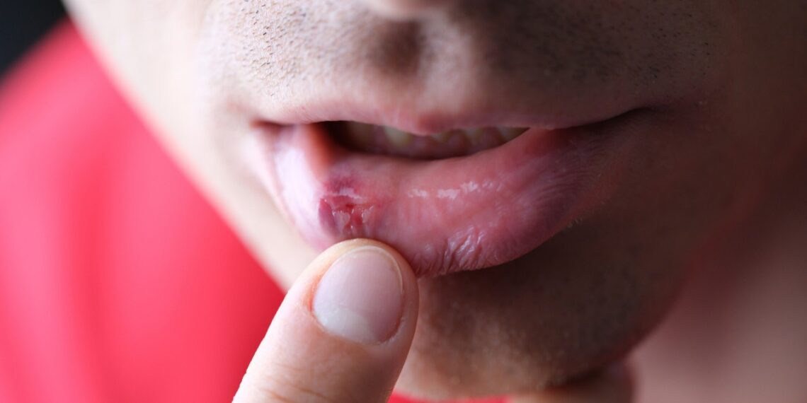 Herpes, entre las principales causas de consulta dermatológica que portan al menos 7 de cada 10 personas