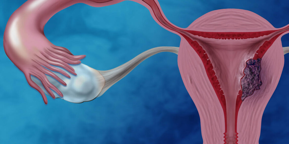 Prevén futuro alentador en terapias para cáncer de endometrio
