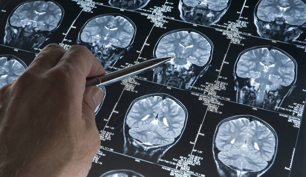 El alzhéimer es la principal causa de muerte en Japón desde 2015, según estudio