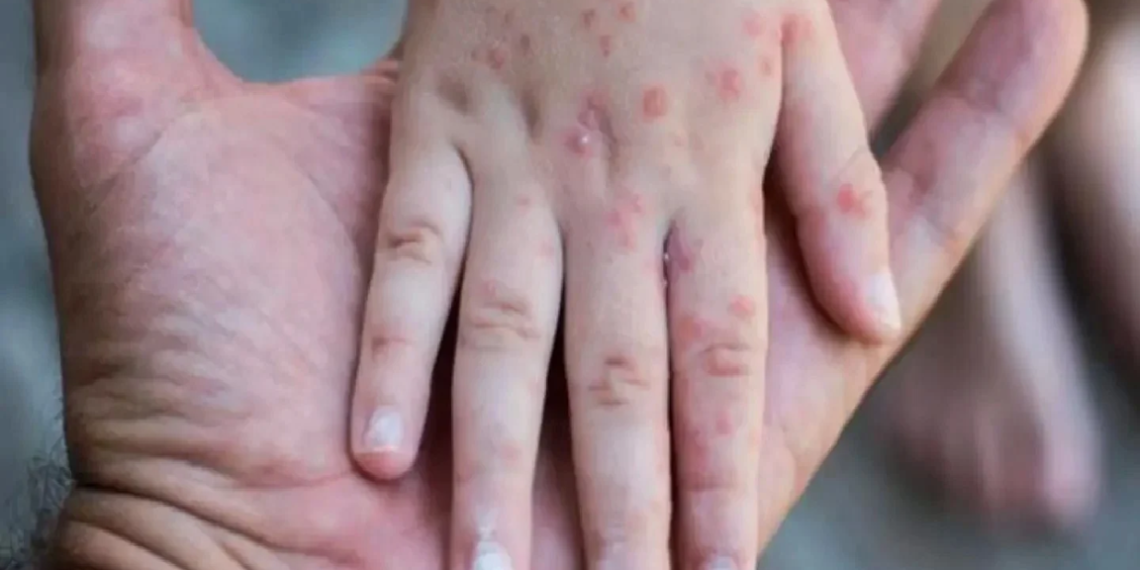 En México hay actualmente 362 casos de sarampión; Ssa reporta un deceso