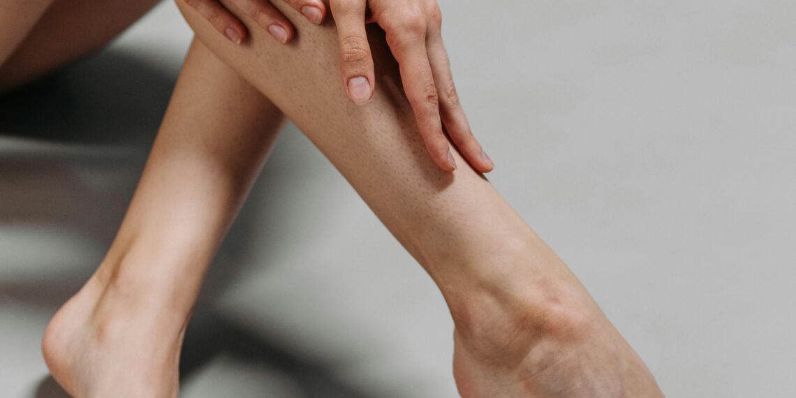 La insuficiencia venosa crónica en México representa un desafío para la salud pública