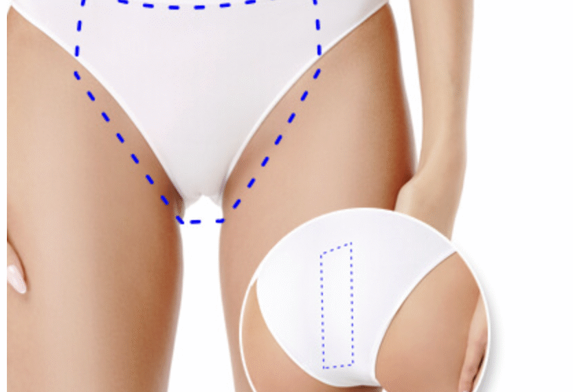 Kopay: depilación láser de barba, axilas y bikini en tendencia