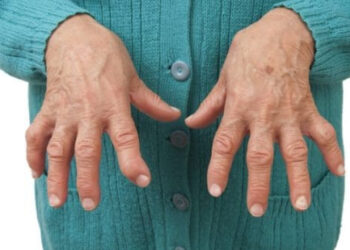 La artritis reumatoide afecta mucho más que las articulaciones: hasta 1 de cada 2 pacientes sufre síntomas depresivos