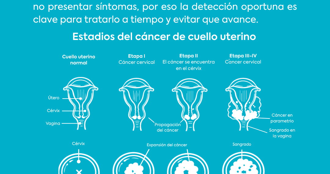 Día Mundial del Cáncer de Cuello Uterino: prevenir puede hacer la diferencia