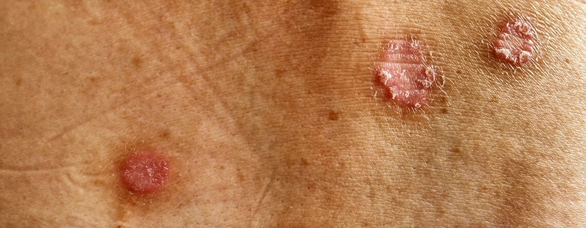 31 millones de personas en México viven con alguna enfermedad de la piel. ¿Cómo reconocer la Hidradenitis Supurativa?