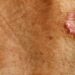 31 millones de personas en México viven con alguna enfermedad de la piel. ¿Cómo reconocer la Hidradenitis Supurativa?